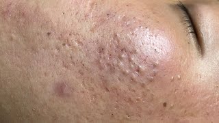 ACNE TREATMENT VU QUYNH MI  Blackheads On Boy Face 2024FULL [upl. by Besnard75]