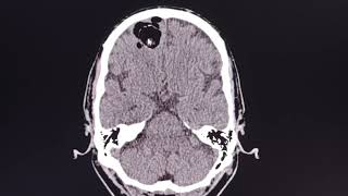 Dermoid cyst  ruptured   rare intracranial lesion [upl. by Ahseekal]