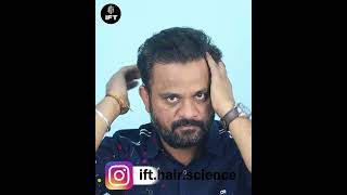 Best hair transplant clinic in Jaipur hairtransplantinlahore ifthairscience jaipurhairclinic [upl. by Walley649]