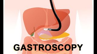 Gastroscopy  Safe diagnostic test if you are suffering from acidity gas bloating vomiting amp reflux [upl. by Evangelin115]