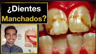 Manchas en los dientes por fluorosis dental Causas y tratamiento [upl. by Tutt]