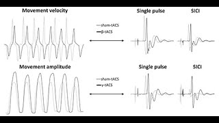 Driving motor cortex oscillations modulates bradykinesia in Parkinson’s disease [upl. by Ynamad150]