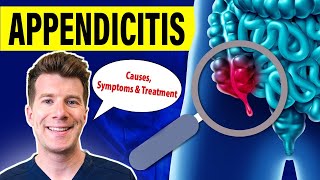 Doctor explains APPENDICITIS  Causes symptoms and treatment [upl. by Eidde]