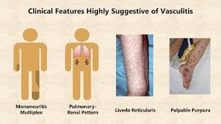 Vasculitis  An Overview [upl. by Marilla]