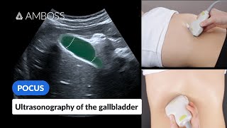 Point of Care Ultrasound of the Gallbladder  AMBOSS Video [upl. by Nonnad]