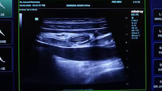 Mesenteric Lymphadenitis Ultrasound [upl. by Anairo781]