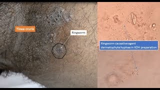 Ringworm and its causative agent dermatophyte under microscope [upl. by Awahsoj]