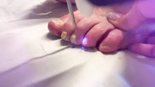 MYCOSE DES ONGLES AU LASER [upl. by Elehcor445]