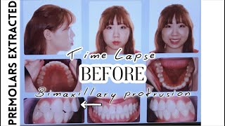 Braces Time Lapse 2 years 8 months⎥4 Premolars Extracted Bimaxillary Protrusion Side Profile [upl. by Cinimod221]