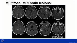 Antibody Prevalence in Epilepsy and Encephalopathy APE2 Score [upl. by Priscilla]