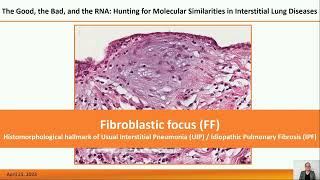 The Good the Bad and the RNA Hunting for Molecular Similarities in Interstitial Lung Diseases [upl. by Yraht409]