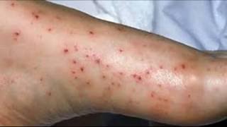 Comment traiter Pinpoint Petechiae [upl. by Yelac]