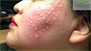 Acne Scar Treatment TCA Cross using TCA 80 [upl. by Bish]