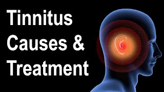 What is Tinnitus Causes amp Treatment Strategies [upl. by Meadows]