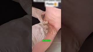 Can a Bee Cure Varicose Veins 😱 [upl. by Isej558]