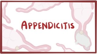 Appendicitis  causes symptoms diagnosis treatment amp pathology [upl. by Iphigeniah]