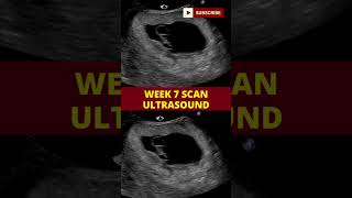 ultrasound scan week 7  pregnancy scan  week by week pregnancy [upl. by Quent]