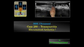 Ultrasound Case 280  Tenosynovitis of the Wrist Rheumatoid Arthritis [upl. by Yorgerg]