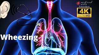 Lung Sounds  Expiratory WHEEZING Sound  Abnormal Breath Sounds  Adventitious Sounds [upl. by Morez464]