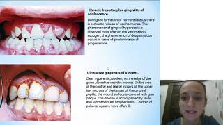 Periodontitis in children [upl. by Wiggins4]