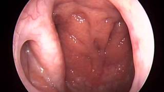 Nasopharyngoscopy nasopharynx adenoid tuba eustachius [upl. by Jasmin]