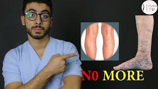 ما هى دوالى الساقين ؟  علاج مشكلة الدوالى نهائيا varicose veins treatment [upl. by Ellan]