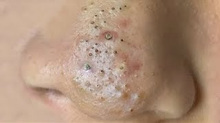 Big Cystic Acne Blackheads Extraction Blackheads amp Milia Whiteheads Removal Pimple Popping  4439 [upl. by Nolyar31]