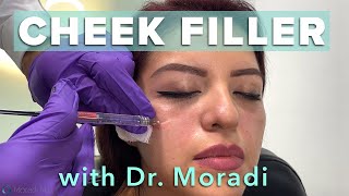 Watch This Patient Get Cheek Filler Before amp After Restylane Contour [upl. by Sarid]