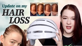 My Hair Loss Experience Update  Rogaine and CurrentBody Skin LED Hair Regrowth Device Review [upl. by Luap]