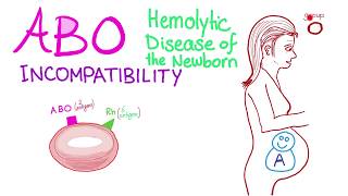 ABO Incompatibility  Hemolytic Disease Of The Newborn HDN  Hematology amp Pathology [upl. by Noj708]