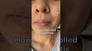 Lip Cheilitis  Lip disease that looks like very dry chapped lips but ITS NOT cheilitis [upl. by Divadleahcim]