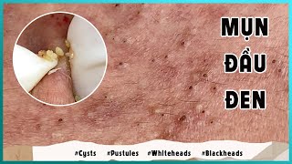 Big Cystic Acne Blackheads Extraction Blackheads amp Milia Whiteheads Removal Pimple Popping [upl. by Doowron]