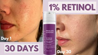 I used Paulas Choice 1 Retinol Treatment on my acne scars for 30 days  Honest Review [upl. by Baudoin]