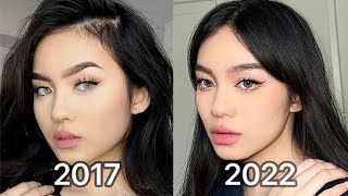 How I Changed My Face lip injections amp botox after 5 years [upl. by Gaskins24]