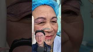 Unconventional Blepharoplasty  Plastic Surgeon Reacts [upl. by Hui354]