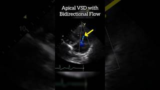 Apical VSD with Bidirectional Flow echocardiography Heart [upl. by Cai]