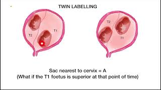 Twin Labelling on USG  Busting the confusion which twin is which  Methods of twin labelling [upl. by Hpeseoj]