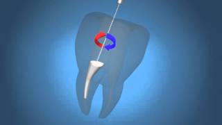 maruchi endoseal root canal filling verenglish [upl. by Aleac875]