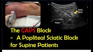 Lateral Popliteal Sciatic Block for Supine Patients CAPS block [upl. by Ihcehcu]