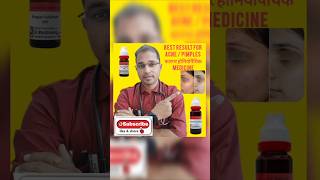 Best result forAcneamp pimples in homeopathic medicine मुंहासे की एक कारगर होम्योपैथिक दवा [upl. by Aleydis]