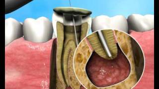 Treatment of Apical Periodontitis  a new approach [upl. by Rehpotsirh]