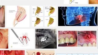 wieso die Wurzelspitzenresektion meistens nichts bringt [upl. by Benilda]