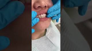 Dental Crown Bridge Placement [upl. by Eudoca]