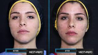 PDOTHREAD LIFT TUTORIAL BY MEDiTHREAD  BROW LIFT [upl. by Akinor]