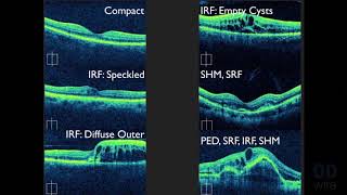 Macular OCT Interpretation A Practical Discussion with Dr David E Lederer [upl. by Elyac]