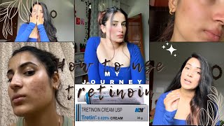 How to use tretinoin 0025 my journeyE2 tretinoin tretinoincream myjourney acnetreatment [upl. by Ardnnaed]