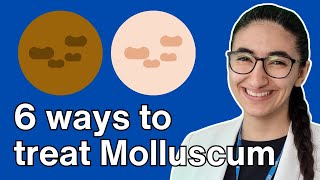 How to treat molluscum contagiosum with Pharmacist Virginia [upl. by Htirehc]