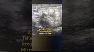 Breast mass breast cancer ultrasound findings [upl. by Laris305]