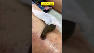 Leech therapy ☝️for skin diseases 🌿 skindiseases leechtherapy panchakarmatherapy healthtips [upl. by Trevar]