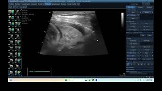 IQ 290 TFAST LUNG MASS ULTRASOUND ICP CPP ECHOPAC ANALYSIS 0 [upl. by Zetram]